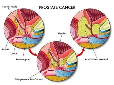 Prostate Cancer Treatment Results in Permanent Injury