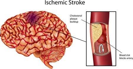 Neurology expert witness discusses ischemic stroke and emergency room treatment