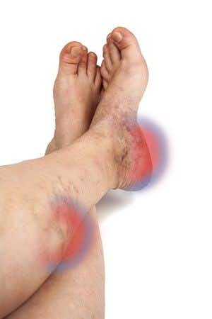 Misdiagnosis of Compartment Syndrome Leads to Foot Drop