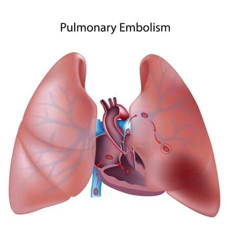 Cardiothoracic Surgery Procedure Results in Pulmonary Embolism and Neurological Damage