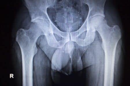 Hip Replacement Recipient Suffers Foot Drop, Nerve Damage Due to Alleged Surgeon Negligence