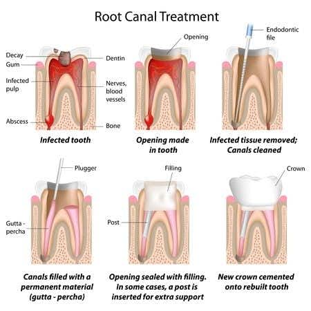 Dental Expert Witness Advises on Alleged Root Canal Treatment Malpractice