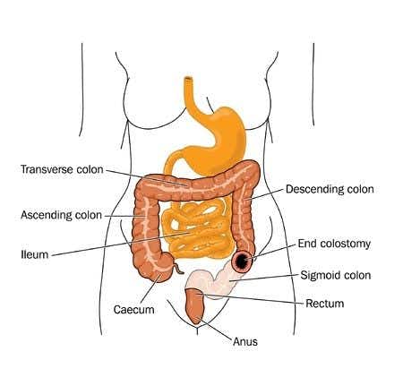 Bariatric surgery expert witness discusses fatal small bowel obstruction