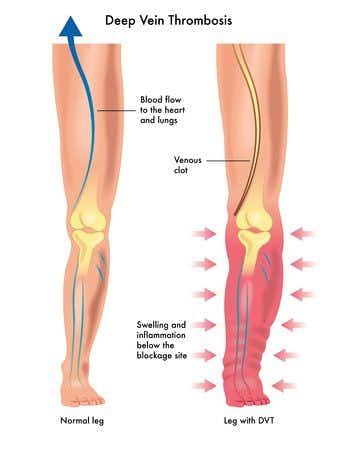 Misdiagnosis of Deep Vein Thrombosis by Emergency Medicine Physician
