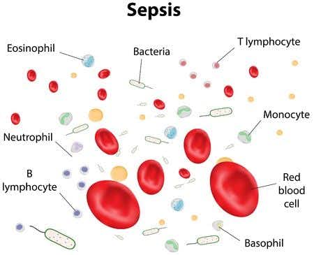 Infectious disease expert witness advises on sepsis fatality that lead to wrongful death action