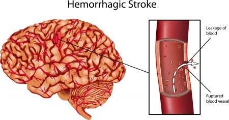 Hematology expert witness advises on anticoagulation in patients at risk for stroke