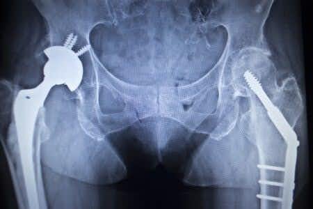 Allegedly Defective Hip Implant Causes Metallosis in Patient