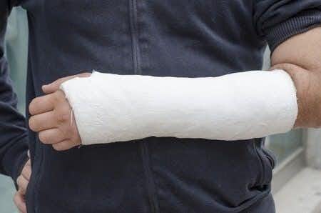 Delayed Ulnar Nerve Repair Results in Permanent Damage