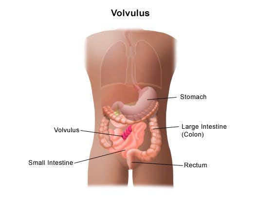 Child Dies From Bowel Necrosis After Failure to Diagnose Volvulus