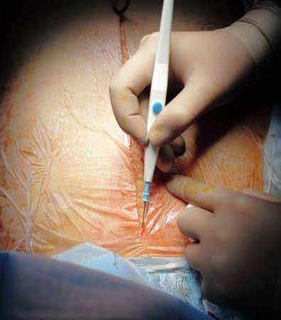 Plastic Surgeon Performs Abdominoplasty Causing Keloid Scarring