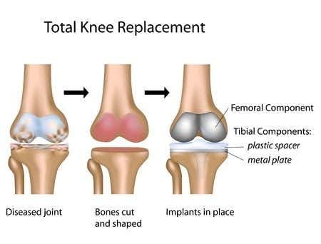 Orthopedic surgery expert witness advises on defective knee replacement