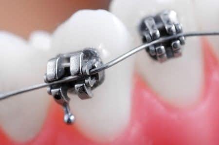 Orthodontics Expert Evaluates Inadequate Imaging Before Implant Surgery