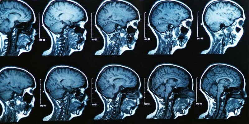 Delayed MRI Allegedly Leads To Patient&#8217;s Rapid Neurological Decline