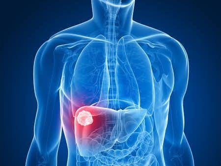 Gastroenterology expert witness advises on failure to monitor a patient who suffers liver damage due to hepatotoxicity