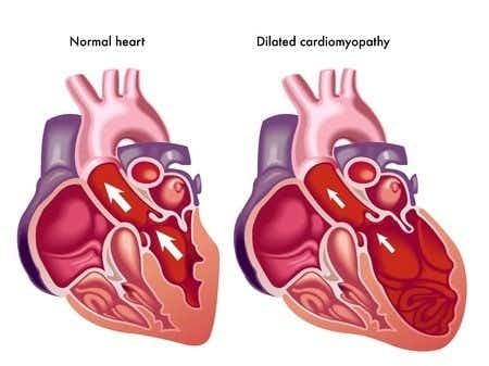 Oncology Expert Witness Opines on Cardiomyopathy After Herceptin