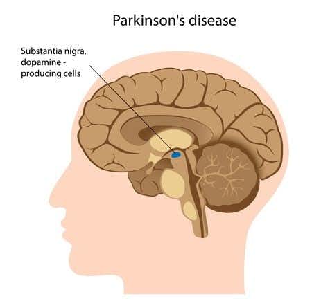 Internal Medicine Physician Prescribes Haldol to Parkinson&#8217;s Patient