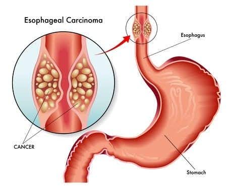 Physician Fails to Diagnose GERD Resulting in Esophageal Carcinoma