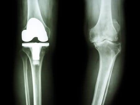 Orthopedic Surgery Expert Witness Comments on Total Knee Replacement