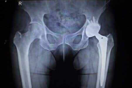 Metal Hip Implant Suffers Catastrophic Failure