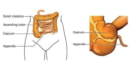 Delayed Diagnosis of Appendicitis Results in Ruptured Appendix