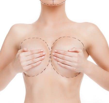 Breast Reduction Surgery Leads to Chronic Infection of Surgical Site