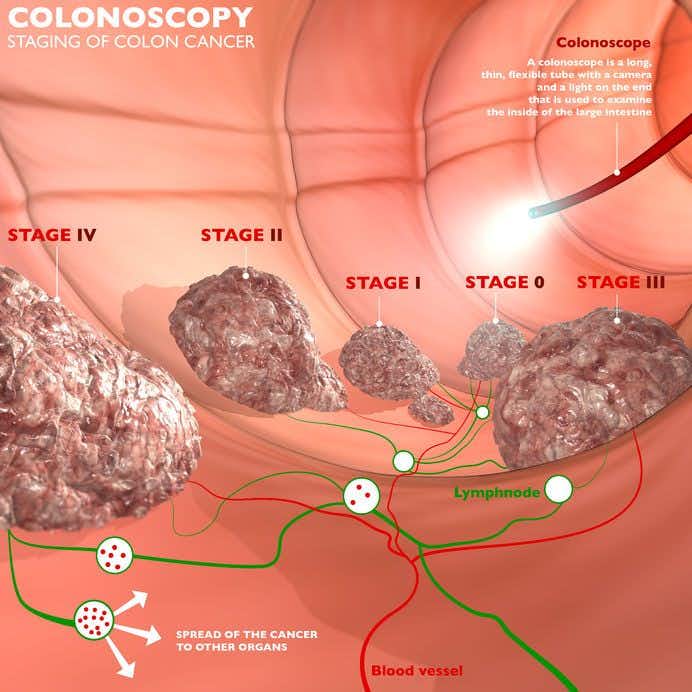 Oncology Experts Discuss Inadequate Screening Procedures For Patient With Advanced Colon Cancer