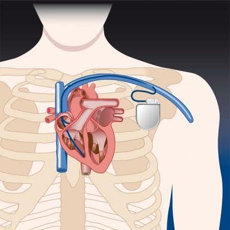 Cardiology Expert Witness Advises on Faulty Pacemaker That Caused Man’s Death