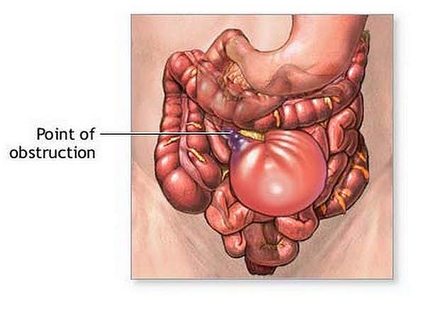General Surgery Expert Witness Advises on Undiagnosed Small Bowel Obstruction Which Went Untreated