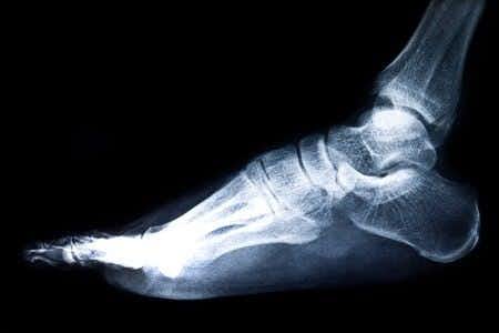 Orthopedic Surgery Expert Evaluates Post-Hip Replacement Foot Drop
