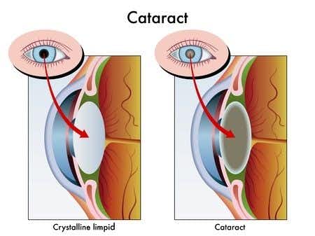 Ophthalmology expert witness advises on cataract surgery that resulted in vision loss from corneal burn